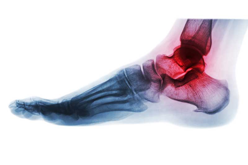 Foot & Ankle Pain in Huntington