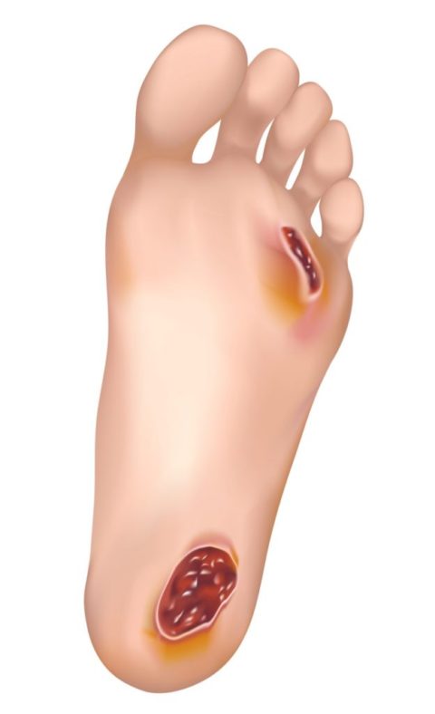 Foot Ulcer Treatment Clinic Orange CA Wound Care Specialist Dr